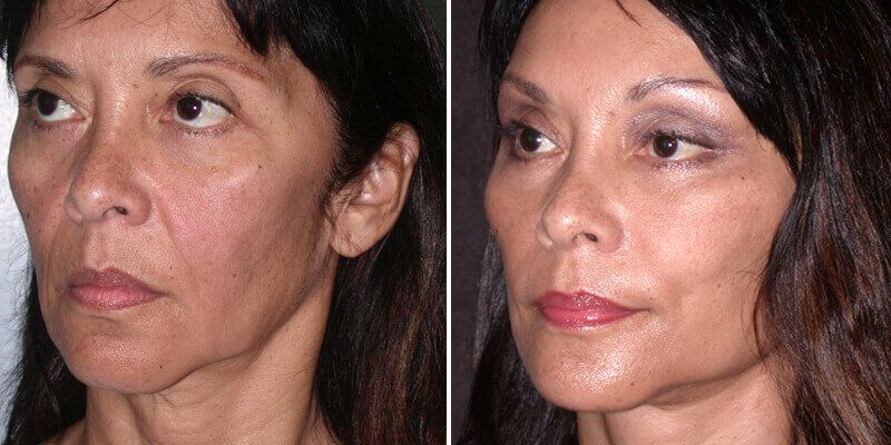 Dr. Kao Ponytail Facelift with Neck Lift
