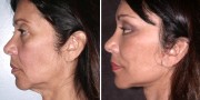 Dr. Kao Ponytail Facelift with Neck Lift
