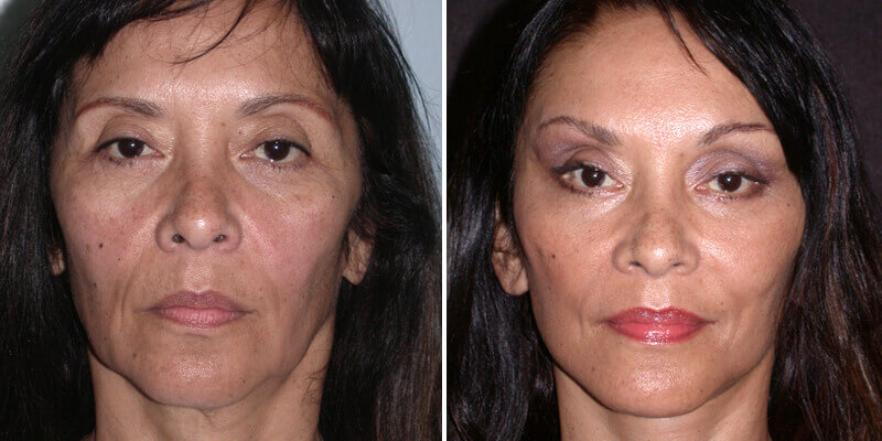 Dr. Kao Ponytail Facelift with Neck Lift