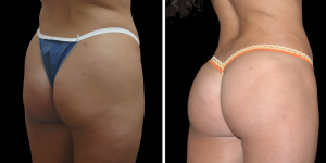 Before and After Buttock Reshaping