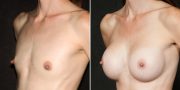 breast augmentation before and after