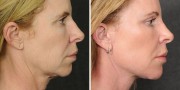 Dr. Kao Ponytail Facelift