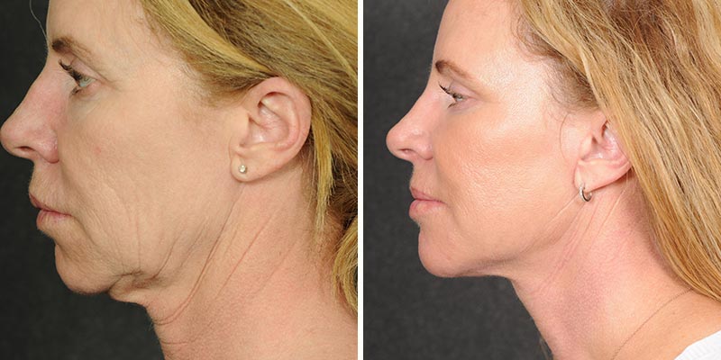 Dr. Kao Ponytail Facelift