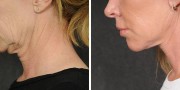 Dr. Kao Ponytail Facelift