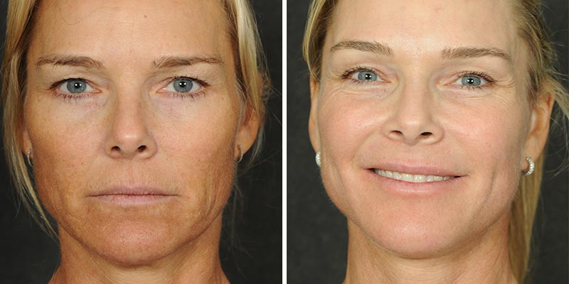 Dr. Kao Ponytail Facelift