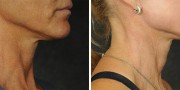 Dr. Kao Ponytail Facelift