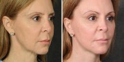 Dr. Kao Ponytail Facelift