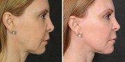 Dr. Kao Ponytail Facelift