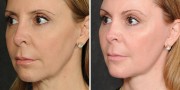 Dr. Kao Ponytail Facelift