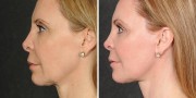 Dr. Kao Ponytail Facelift