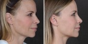 Dr. Kao Ponytail Facelift