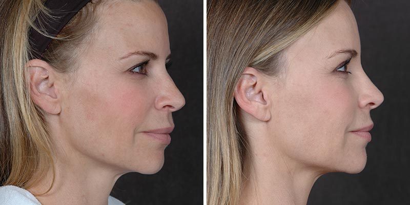 Dr. Kao Ponytail Facelift