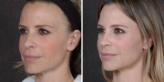 Dr. Kao Ponytail Facelift