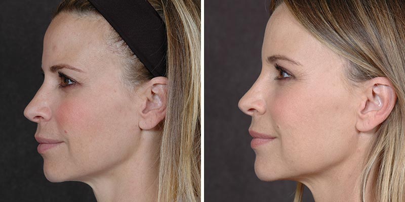 Dr. Kao Ponytail Facelift