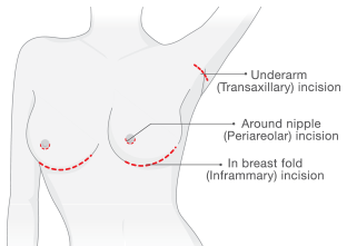 Breast Augmentation | Incision Placement