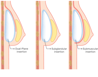 Breast Augmentation | Implant Placement