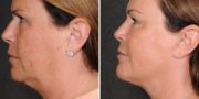 Dr. Kao Ponytail Facelift