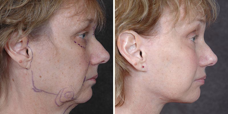 Dr. Kao Ponytail Facelift