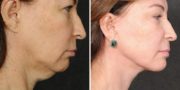 Dr. Kao Ponytail Facelift