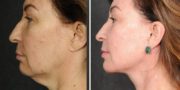 Dr. Kao Ponytail Facelift