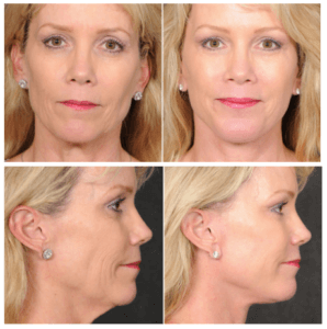 Dr. Kao's Ponytail Facelift Before and After Photos