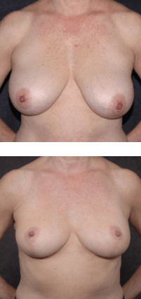 Breast Lift Before and After Photos