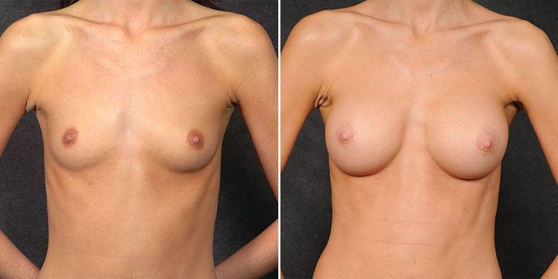 Dr. Kao Breast Augmentation