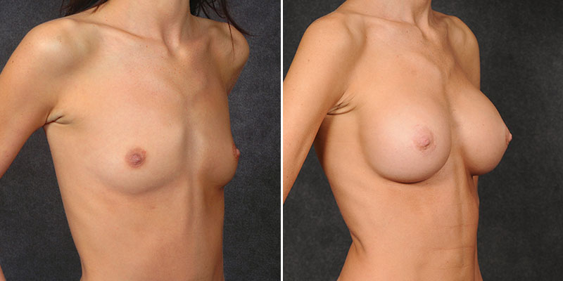 Dr. Kao Breast Augmentation