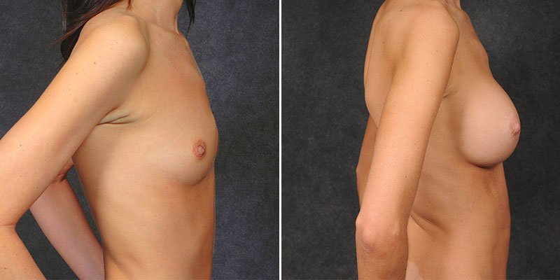 Dr. Kao Breast Augmentation