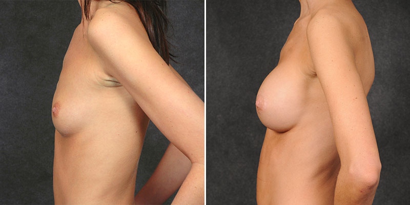 Dr. Kao Breast Augmentation