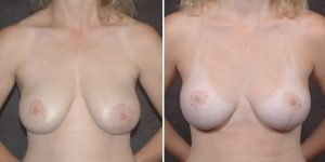 Dr. Kao Breast Lift Patient before and after photos