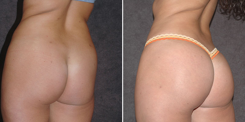 Dr. Kao Stem Cell Fat Transfer Butt Augmentation