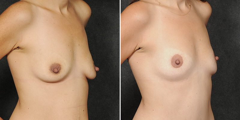 Dr. Kao Breast Lift (Mastopexy)