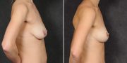 Dr. Kao Breast Lift (Mastopexy)