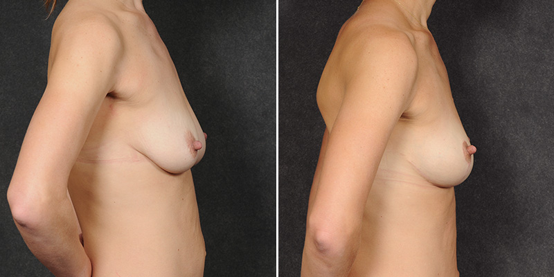 Dr. Kao Breast Lift (Mastopexy)