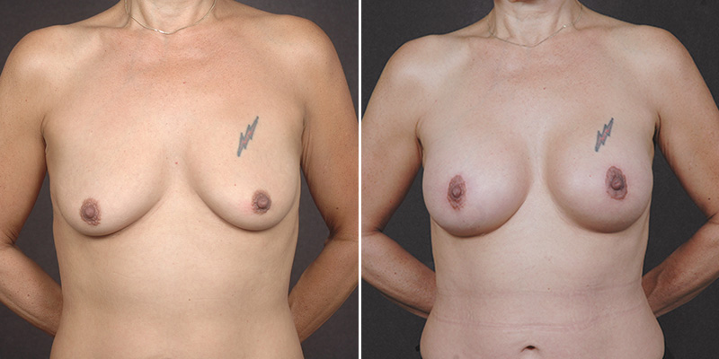 Dr. Kao Breast Lift (Mastopexy) with Implants