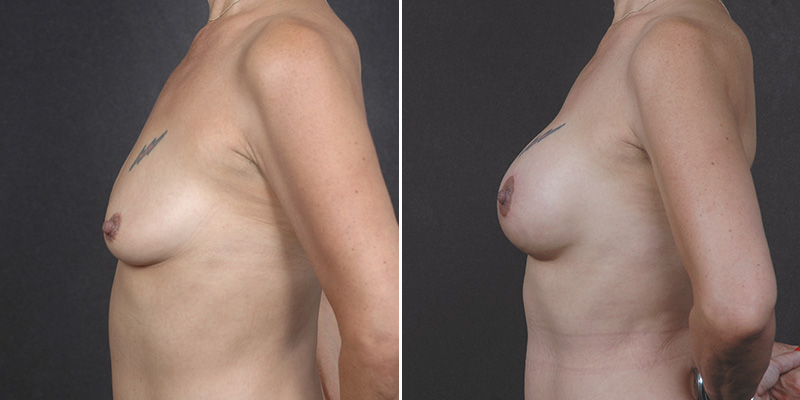 Dr. Kao Breast Lift (Mastopexy) with Implants