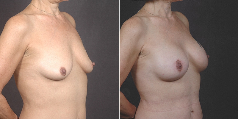 Dr. Kao Breast Lift (Mastopexy) with Implants