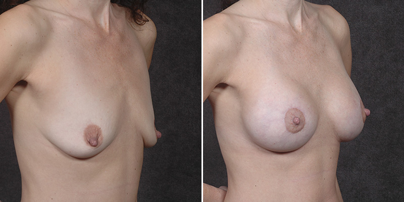 Dr. Kao Breast Lift (Mastopexy) with Implants