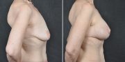 Dr. Kao Breast Lift (Mastopexy) with Implants