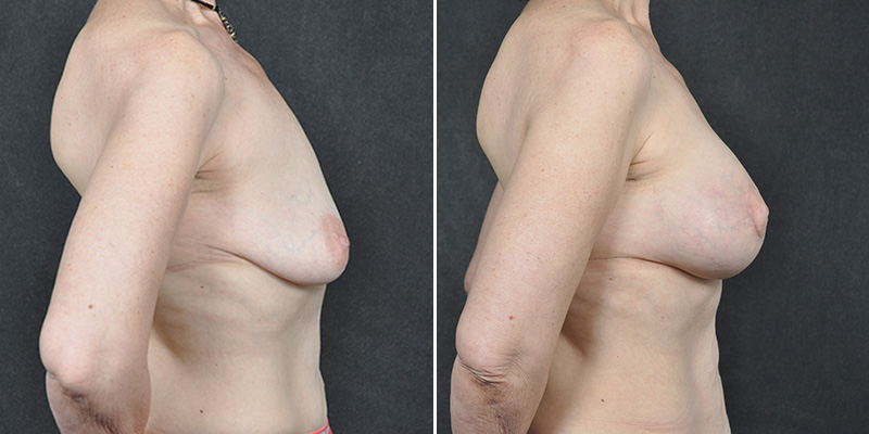 Dr. Kao Breast Lift (Mastopexy) with Implants