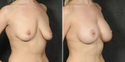 Dr. Kao Breast Lift (Mastopexy) with Implants