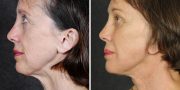 Dr. Kao Ponytail Face Lift