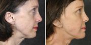 Dr. Kao Ponytail Face Lift