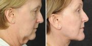 Dr. Kao Ponytail Face Lift