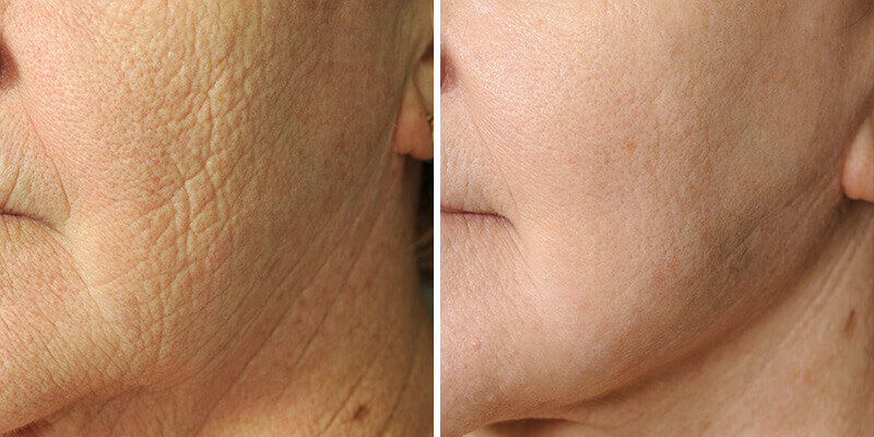 Dr. Kao Ponytail Face Lift