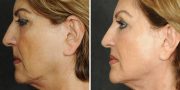 Dr. Kao Ponytail Face Lift