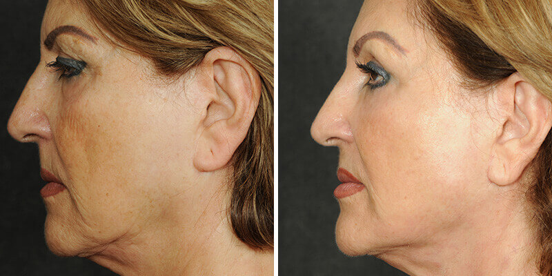 Dr. Kao Ponytail Face Lift