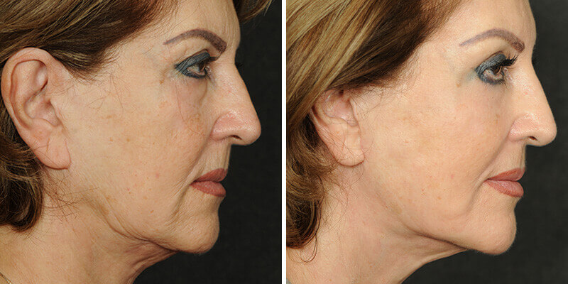 Dr. Kao Ponytail Face Lift