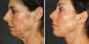 Dr. Kao Ponytail Face Lift